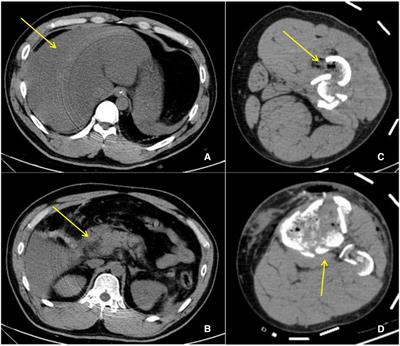 Transient Budd–Chiari syndrome secondary to blunt traumatic bile fistula: A case report